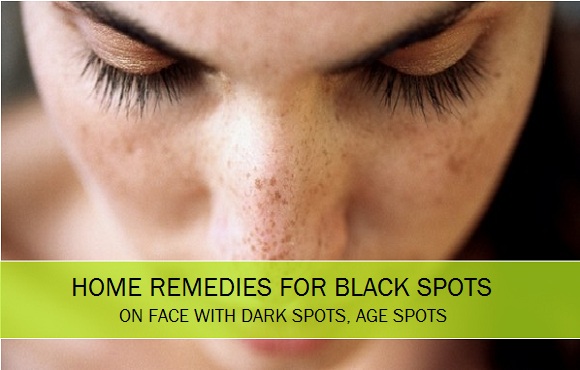 Home remedies for black spots, dark spots, age spots, pimple marks