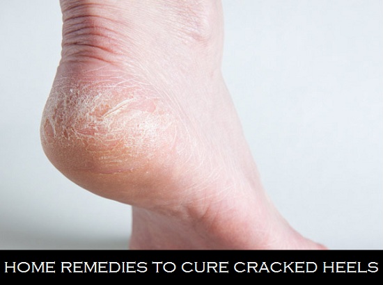 7 Home Remedies For Cracked Feet- Get Baby Soft Heels!