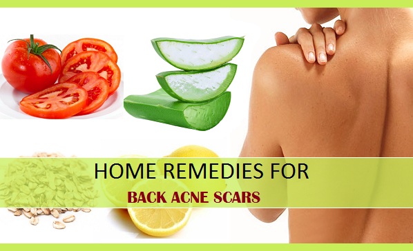 Home remedies for back acne scars