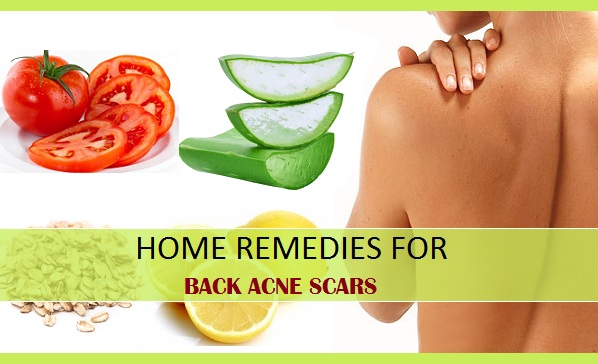 Home Remedies For Back Acne Scars And Marks