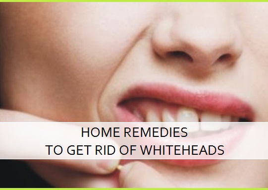 home remedies to get rid of whiteheads fast