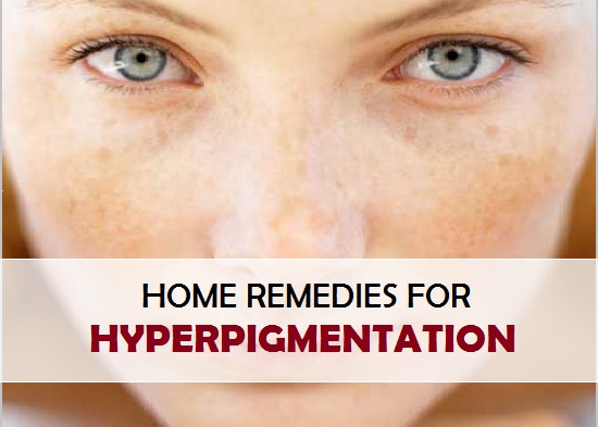 Home remedies for hyperpigmentation cure treatment