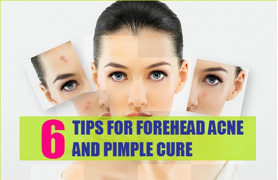Home Remedies for Forehead Acne and Pimples