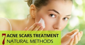 natural acne scar treatment