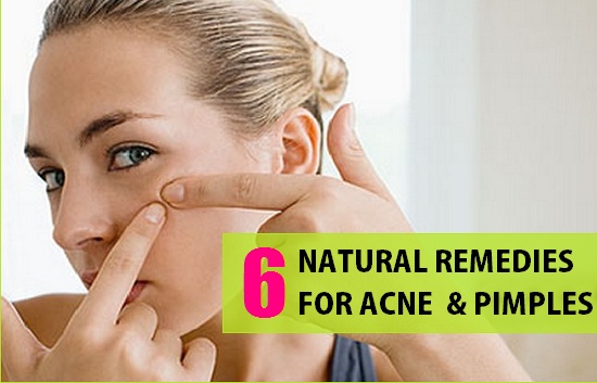 Natural Herbal Remedies for Acne and Pimples