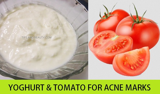 3 Easy Yoghurt Face Masks for Acne Scars and Marks Treatment