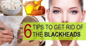 how to get rid of blackheads faster