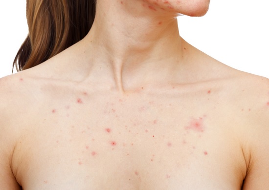 Best Ways to get rid of Chest Acne and Scars