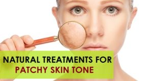 natural treatments for patchy skin tone