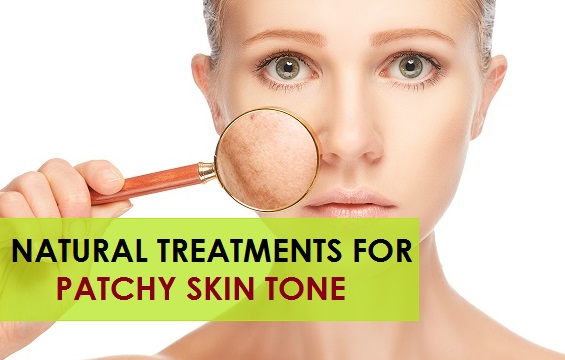 natural treatments for patchy skin tone