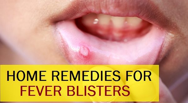 Best Indian Home Remedies To treat the Fever Blisters