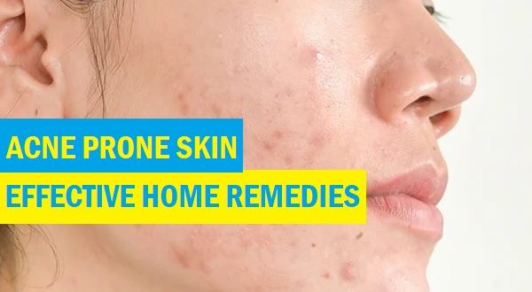 Photo inspiration: Effective Home Remedies For Acne Prone Skin Understanding And Curing Photo Inspiration