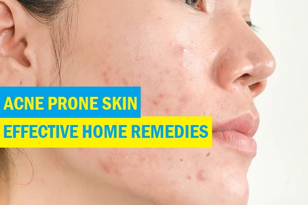 Effective Home Remedies for Acne-Prone Skin