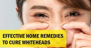 Effective Home Remedies for Whiteheads: Natural Ways to Achieve Clear Skin