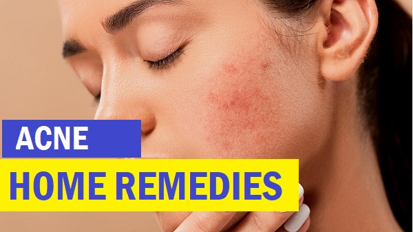 Get Rid Of Acne With Home Remedies And Clinical Treatments
