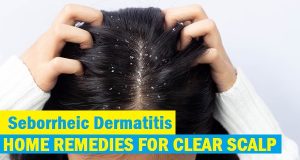 Home Remedies For Seborrheic Dermatitis