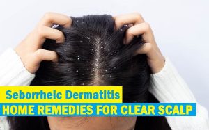 8 Effective Home Remedies For Seborrheic Dermatitis To Get Clear Scalp ...