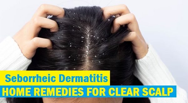 8 Effective Home Remedies For Seborrheic Dermatitis To Get Clear Scalp ...