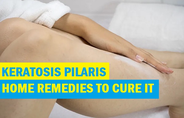 How To Treat Keratosis Pilaris at Home with Natural Remedies