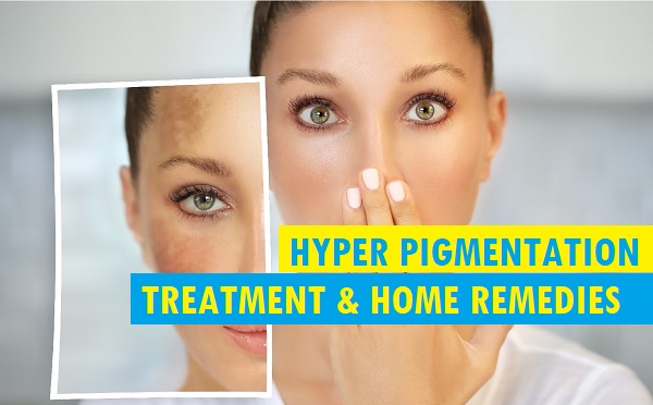 Hyperpigmentation Skin Care: Remedies, Treatments, Precautions, and Prevention