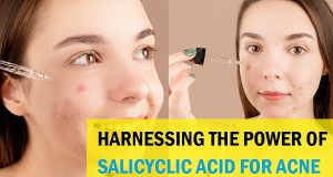 Salicylic Acid For Acne-Prone Skin: A Quick Guide For Clear Radiant Complexion