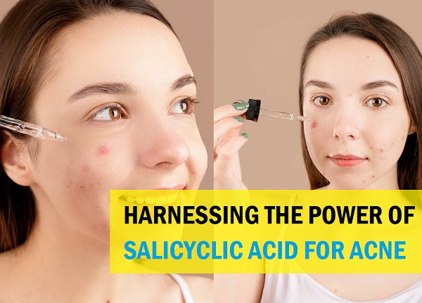 Salicylic Acid For Acne-Prone Skin: A Quick Guide For Clear Radiant Complexion