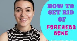 forehead acne home remedies