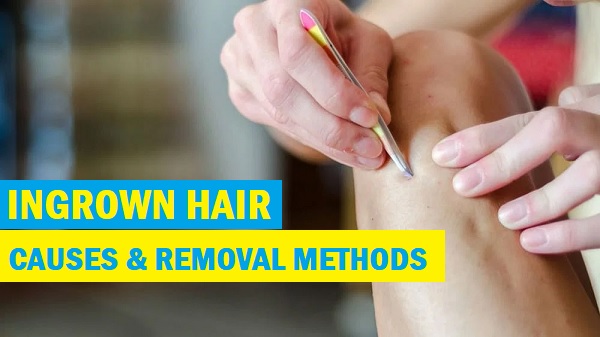 ingrown hair remedies