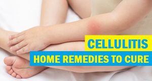 Cellulitis Treatment at Home Natural Remedies for Effective Relief