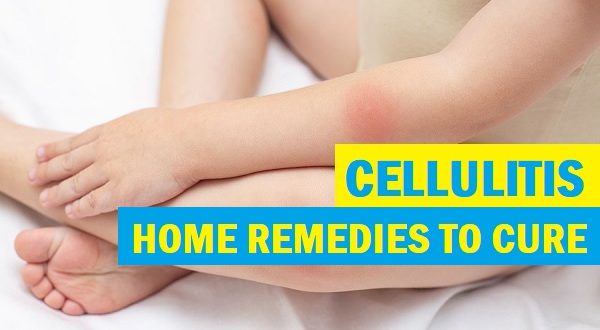 Try 25 Natural Remedies for Cellulitis Treatment at Home & Effective ...