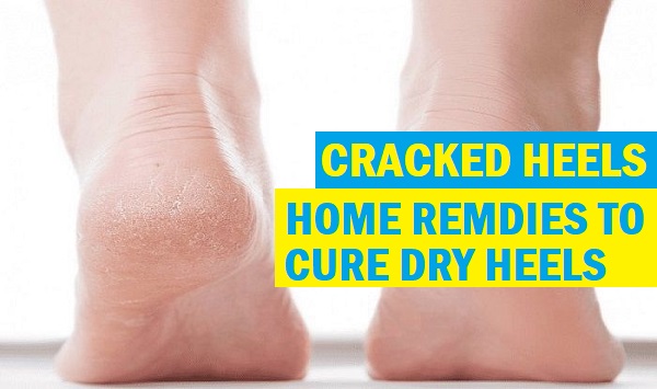 Home Remedies for Dry Cracked Feet: Say Goodbye to Rough Soles
