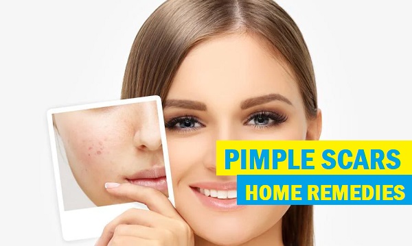 Try These 25 Tested Home Remedies For Pimple Scars Removal Quickly 